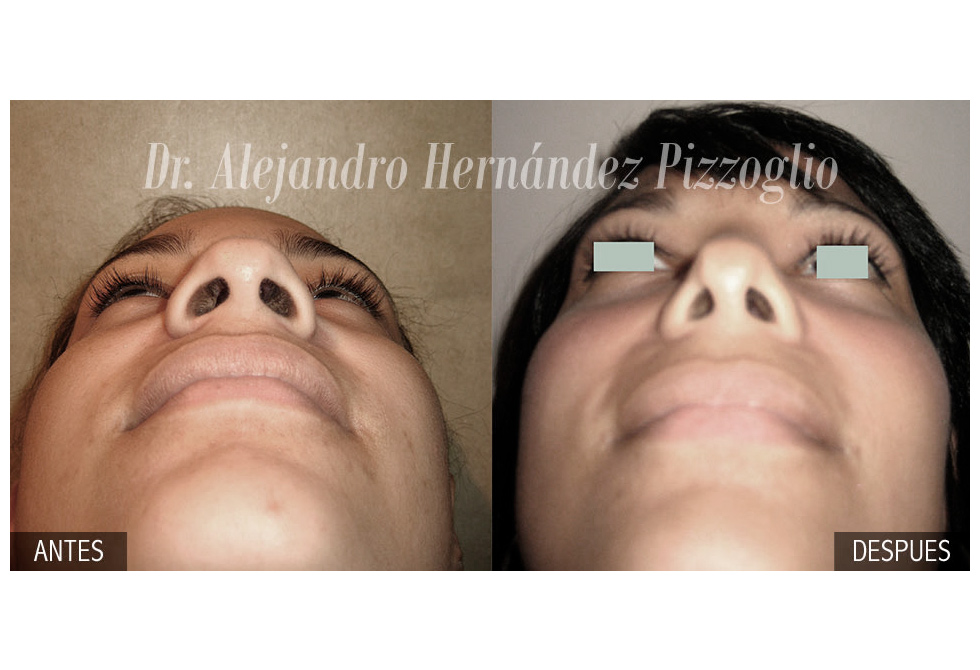 Cirugía Facial – Dr. Alejandro Hernández Pizzoglio